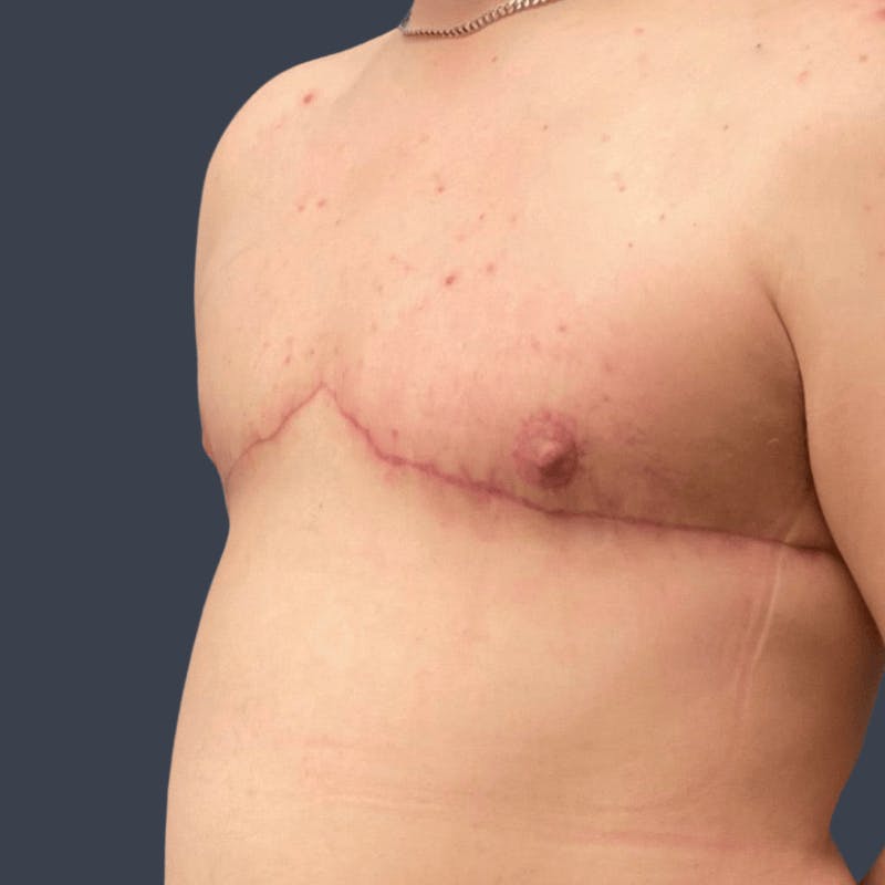 Top Surgery Before & After Gallery - Patient 437110 - Image 6