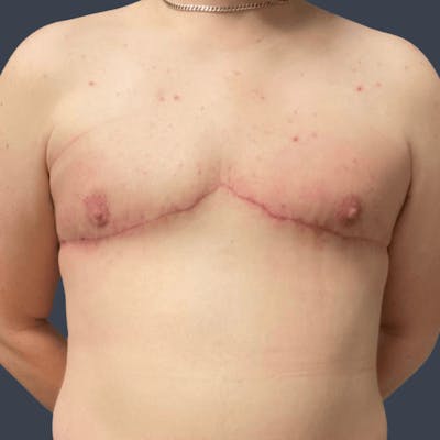 Top Surgery Before & After Gallery - Patient 437110 - Image 2
