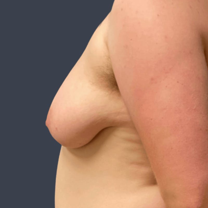 Top Surgery Before & After Gallery - Patient 437110 - Image 5