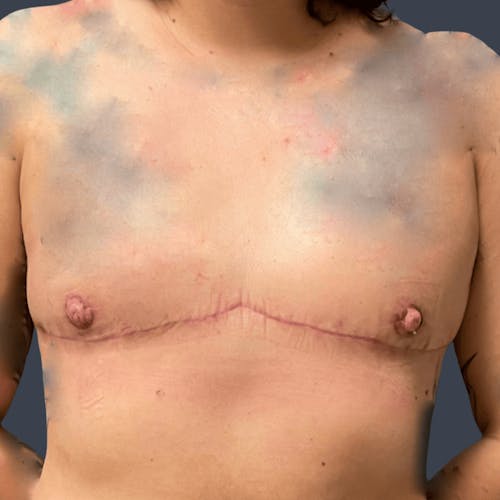 After procedure image for Top Surgery