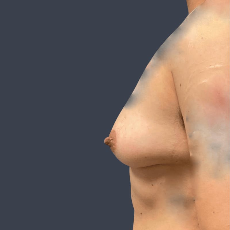 Top Surgery Before & After Gallery - Patient 423661 - Image 3
