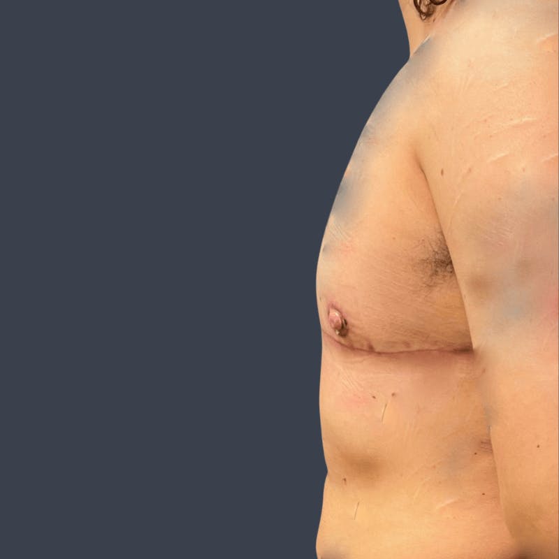 Top Surgery Before & After Gallery - Patient 423661 - Image 4