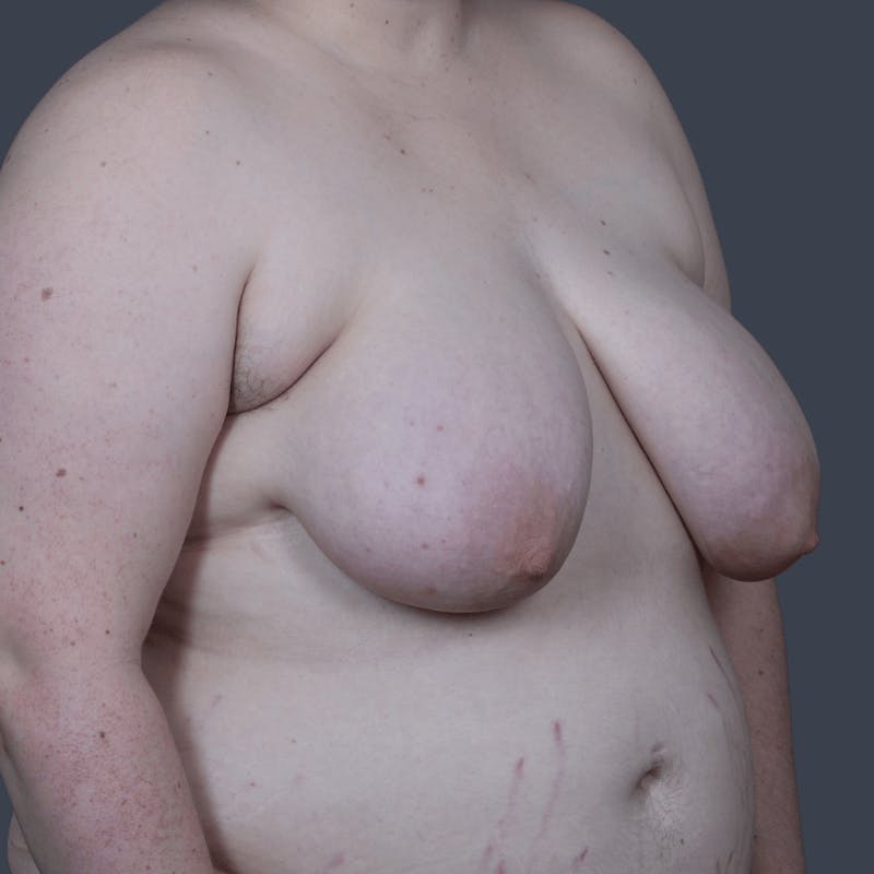 Top Surgery Before & After Gallery - Patient 310057 - Image 3