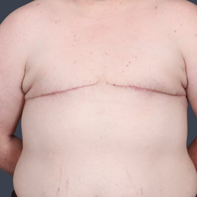 Top Surgery Before & After Gallery - Patient 310057 - Image 2