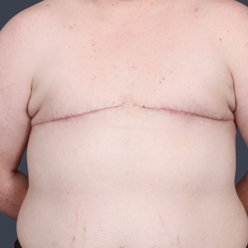 Top Surgery Before & After Gallery - Patient 310057 - Image 2
