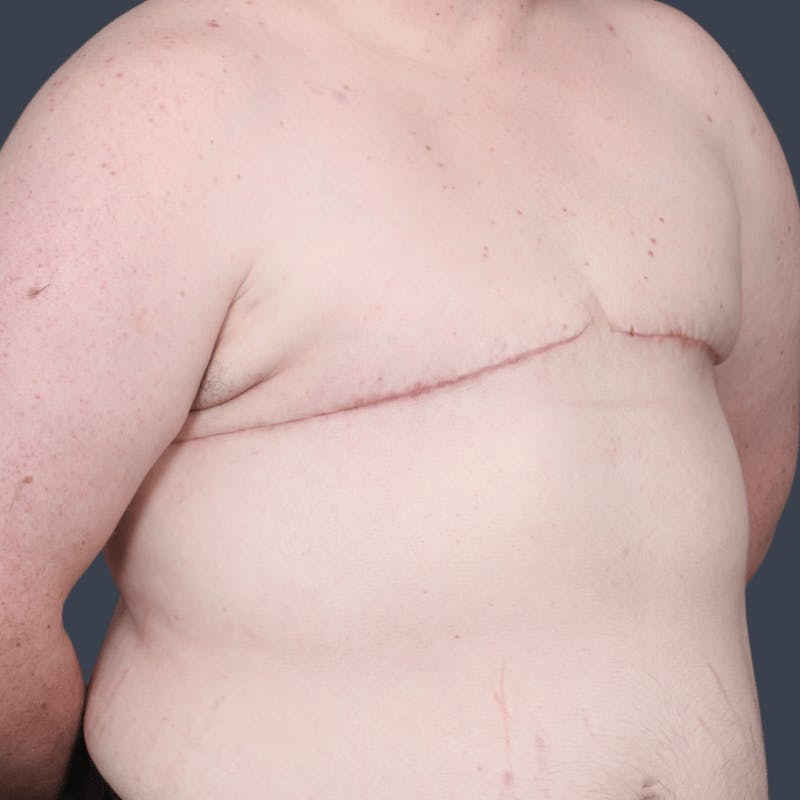Top Surgery Before & After Gallery - Patient 310057 - Image 4