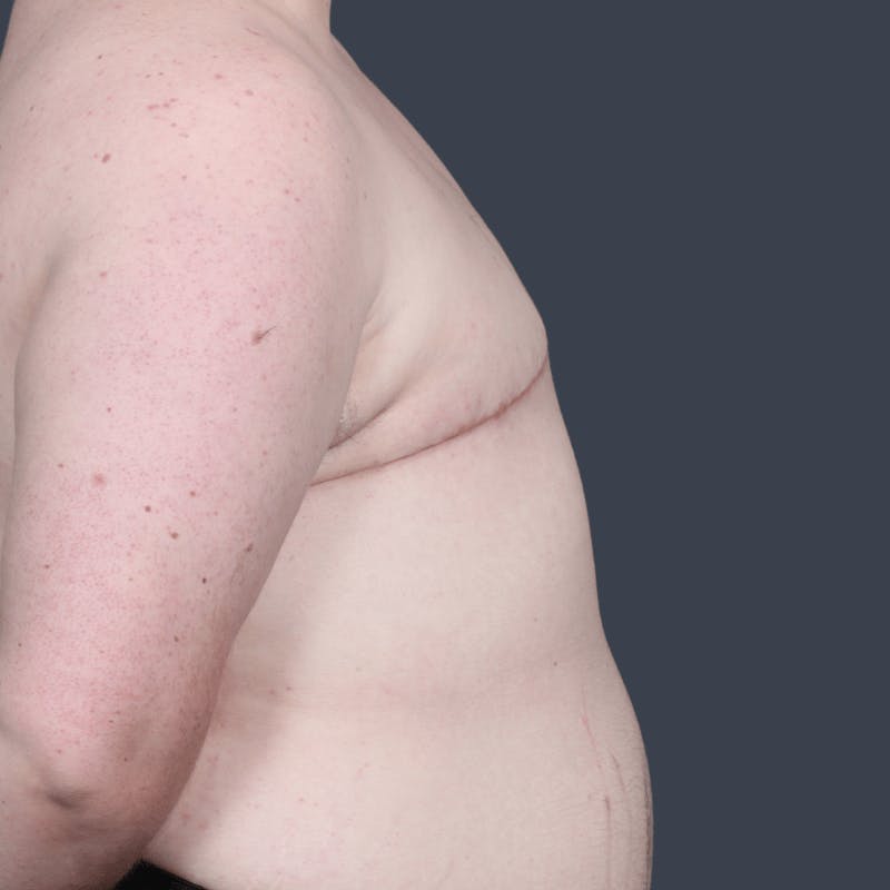Top Surgery Before & After Gallery - Patient 310057 - Image 6