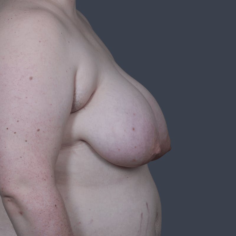 Top Surgery Before & After Gallery - Patient 310057 - Image 5