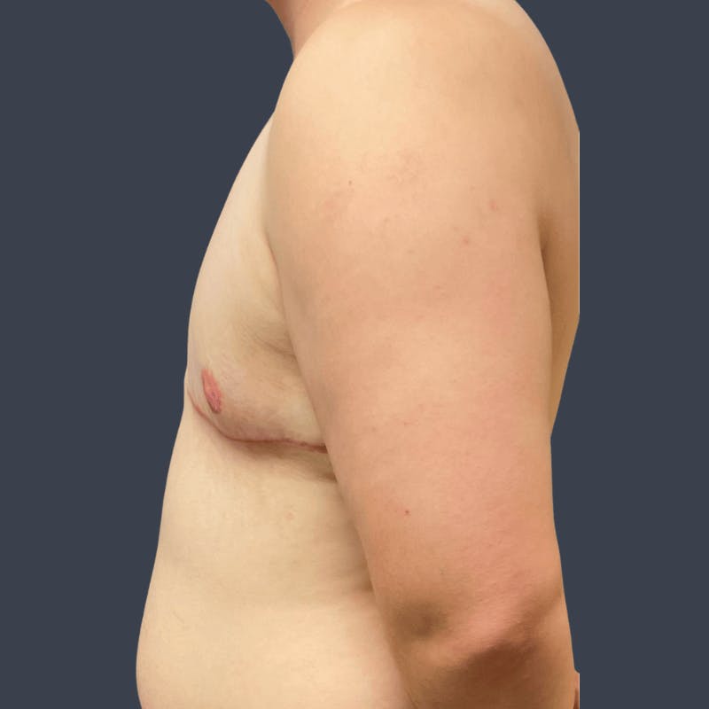 Top Surgery Before & After Gallery - Patient 626997 - Image 4