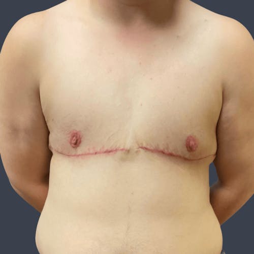 After procedure image for Top Surgery