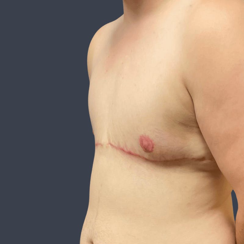 Top Surgery Before & After Gallery - Patient 626997 - Image 6