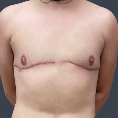 Top Surgery Before & After Gallery - Patient 445152 - Image 2
