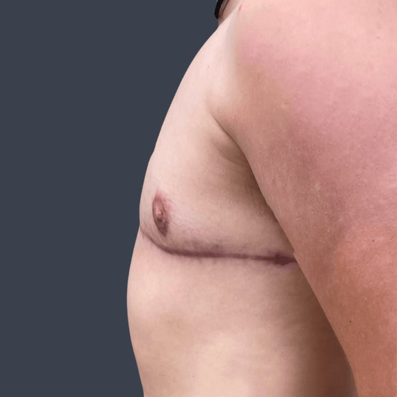 Top Surgery Before & After Gallery - Patient 445152 - Image 4