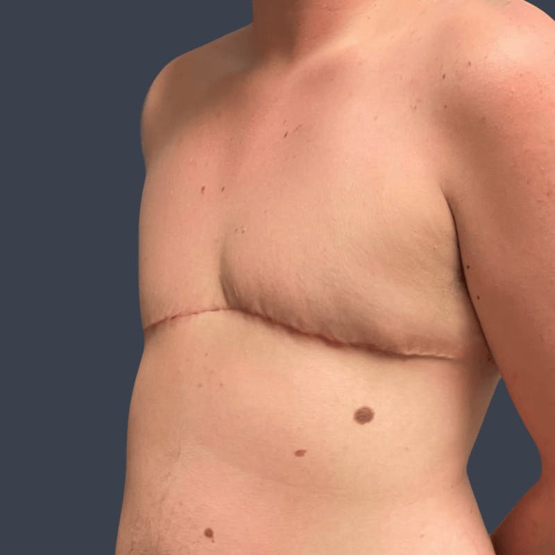 Top Surgery Before & After Gallery - Patient 194529 - Image 4