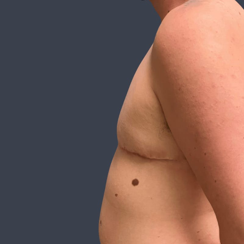 Top Surgery Before & After Gallery - Patient 194529 - Image 6