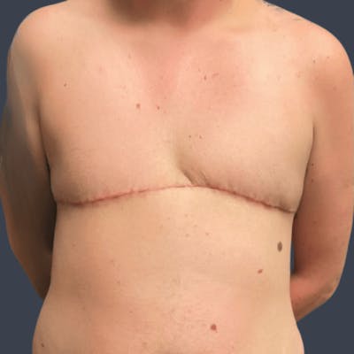 Top Surgery Before & After Gallery - Patient 194529 - Image 2
