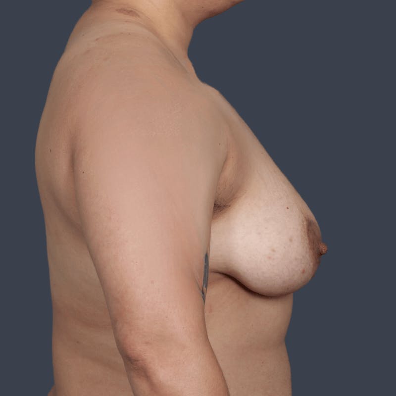 Top Surgery Before & After Gallery - Patient 379242 - Image 3