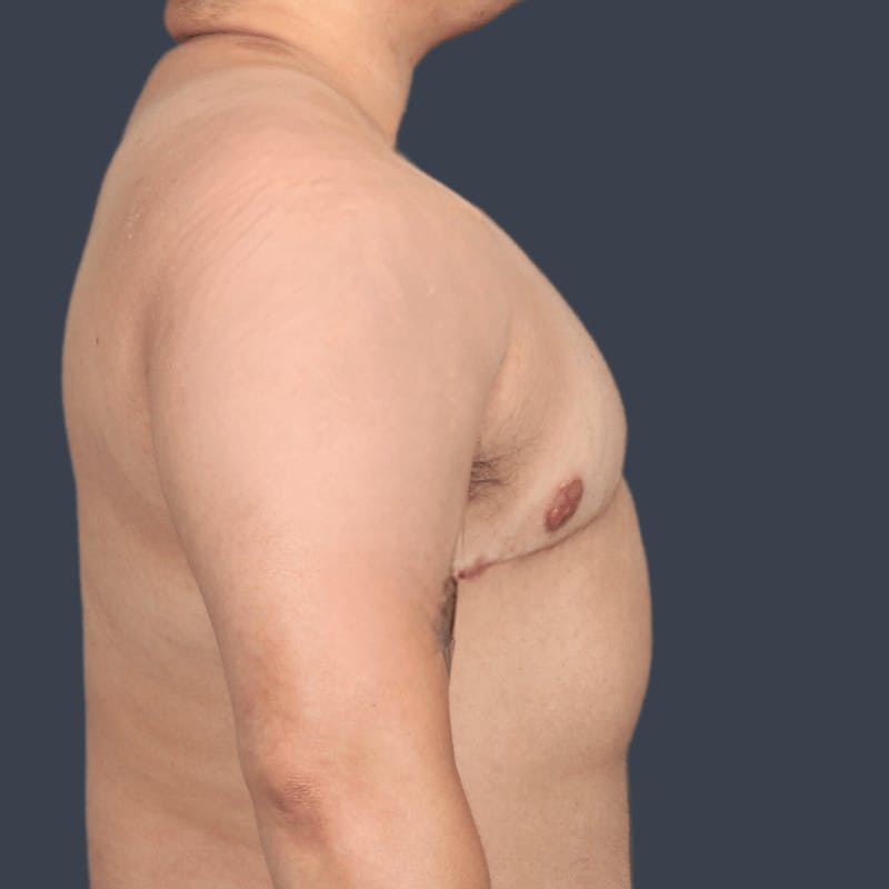 Top Surgery Before & After Gallery - Patient 379242 - Image 4