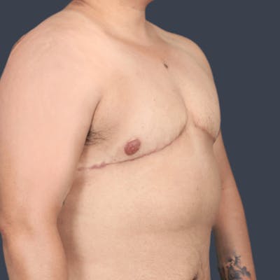 Top Surgery Before & After Gallery - Patient 379242 - Image 2