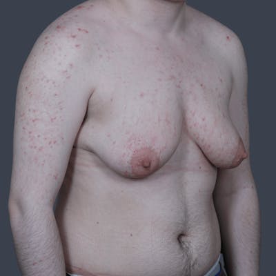 Top Surgery Before & After Gallery - Patient 301679 - Image 1