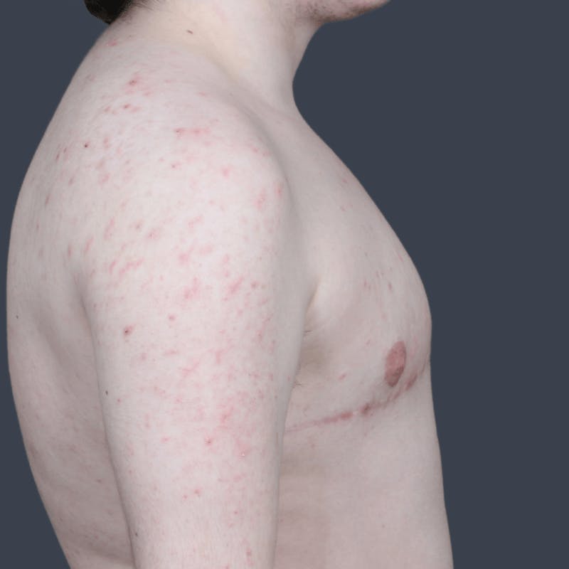Top Surgery Before & After Gallery - Patient 301679 - Image 4
