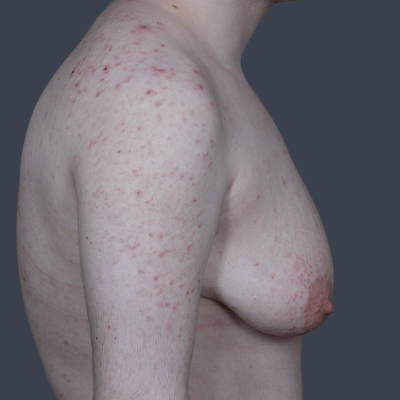 Top Surgery Before & After Gallery - Patient 301679 - Image 3