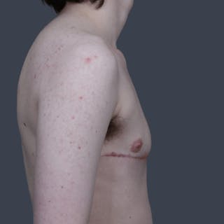 Top Surgery Before & After Gallery - Patient 246355 - Image 6