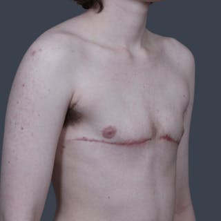 Top Surgery Before & After Gallery - Patient 246355 - Image 4