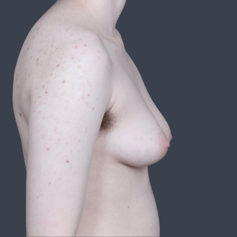 Top Surgery Before & After Gallery - Patient 246355 - Image 5
