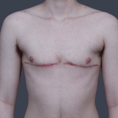 Top Surgery Before & After Gallery - Patient 246355 - Image 2