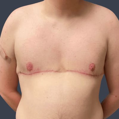 Top Surgery Before & After Gallery - Patient 165845 - Image 2