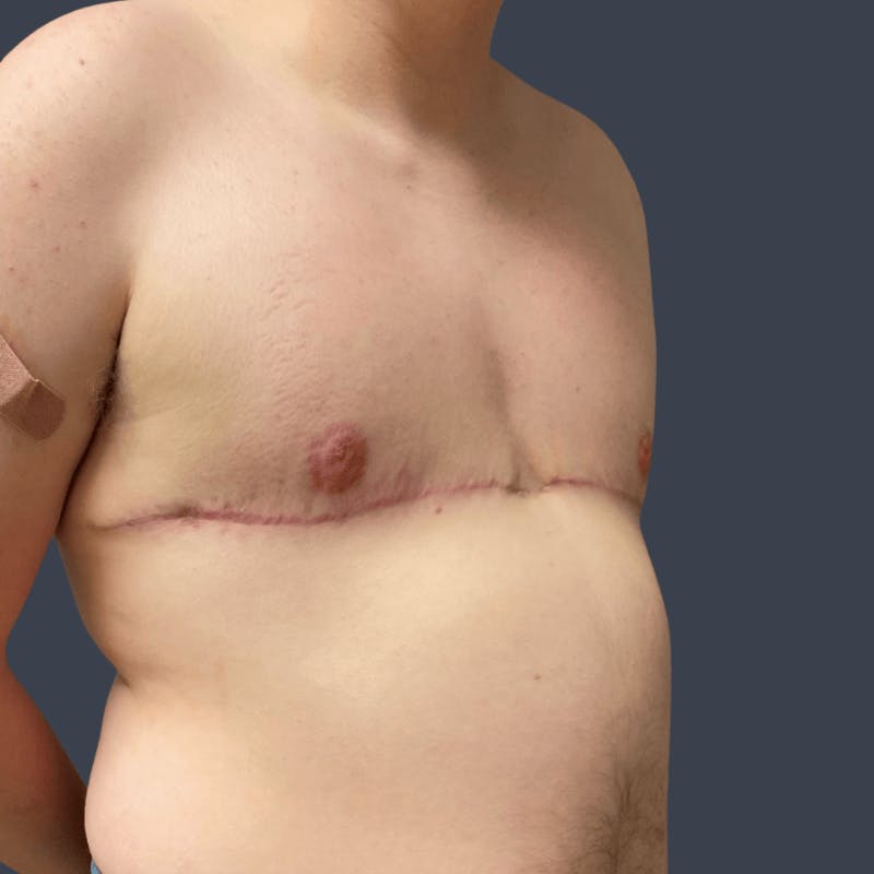 Top Surgery Before & After Gallery - Patient 165845 - Image 4