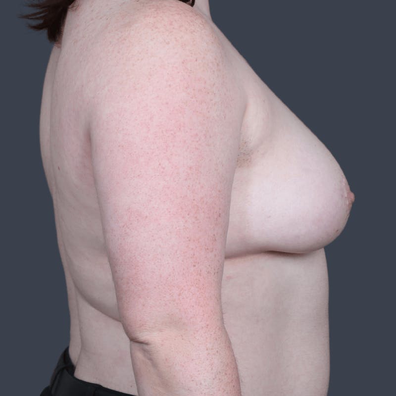 Top Surgery Before & After Gallery - Patient 313947 - Image 5