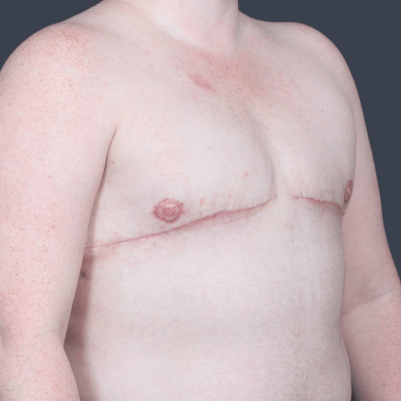 Top Surgery Before & After Gallery - Patient 313947 - Image 4