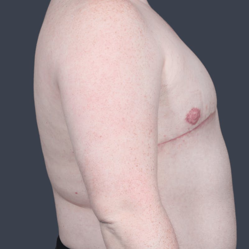 Top Surgery Before & After Gallery - Patient 313947 - Image 6