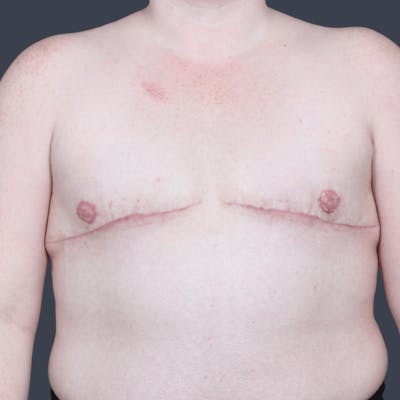 Top Surgery Before & After Gallery - Patient 313947 - Image 2