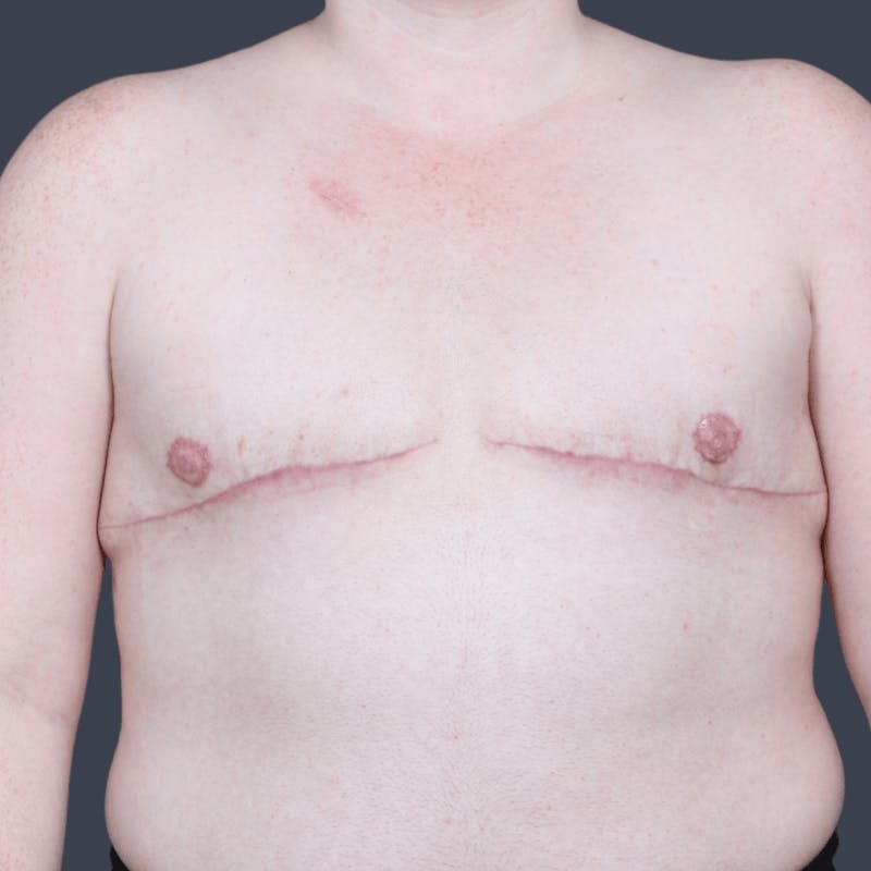 Top Surgery Before & After Gallery - Patient 313947 - Image 2