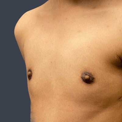 Top Surgery Before & After Gallery - Patient 167442 - Image 2