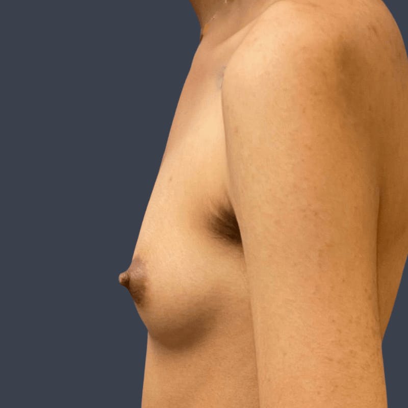 Top Surgery Before & After Gallery - Patient 167442 - Image 3