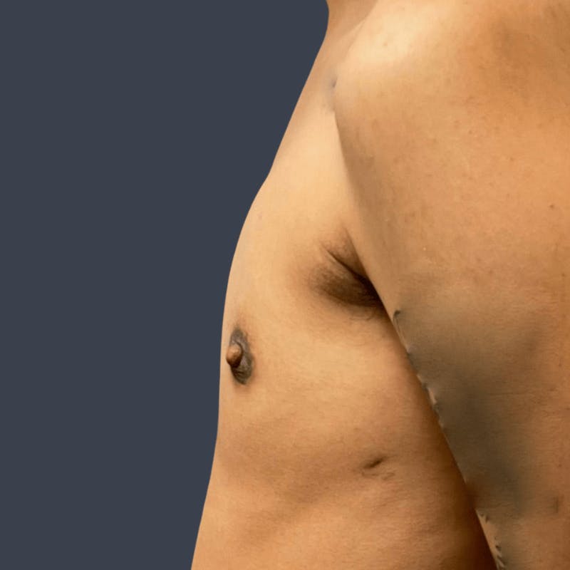 Top Surgery Before & After Gallery - Patient 167442 - Image 4