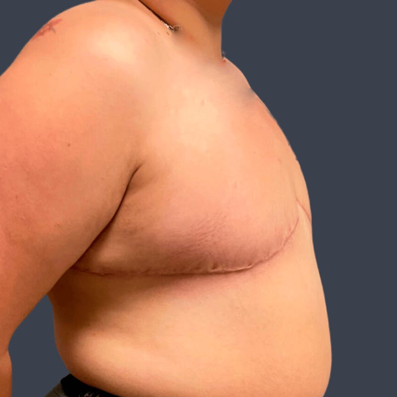 Top Surgery Before & After Gallery - Patient 179721 - Image 4