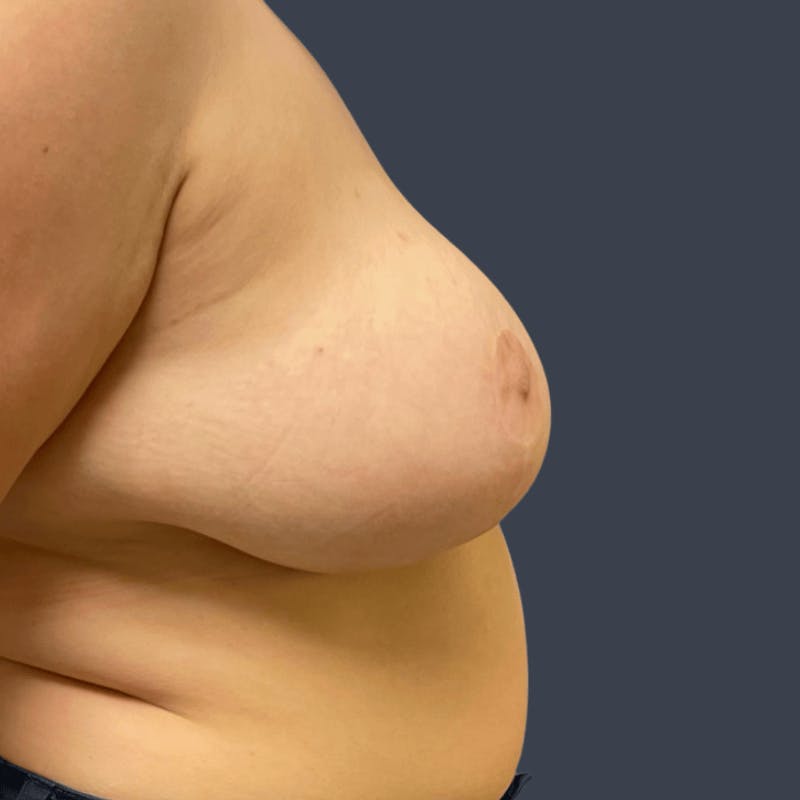 Top Surgery Before & After Gallery - Patient 179721 - Image 3