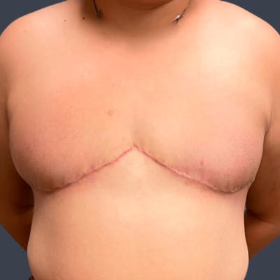 Top Surgery Before & After Gallery - Patient 179721 - Image 2