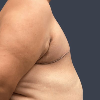 Top Surgery Before & After Gallery - Patient 267043 - Image 2