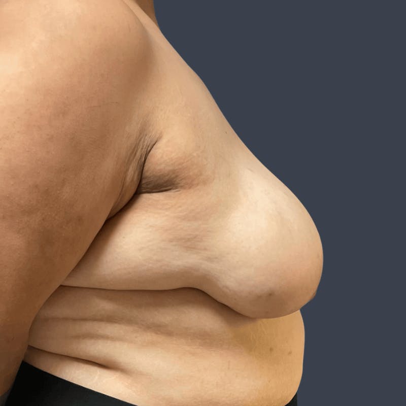 Top Surgery Before & After Gallery - Patient 267043 - Image 3