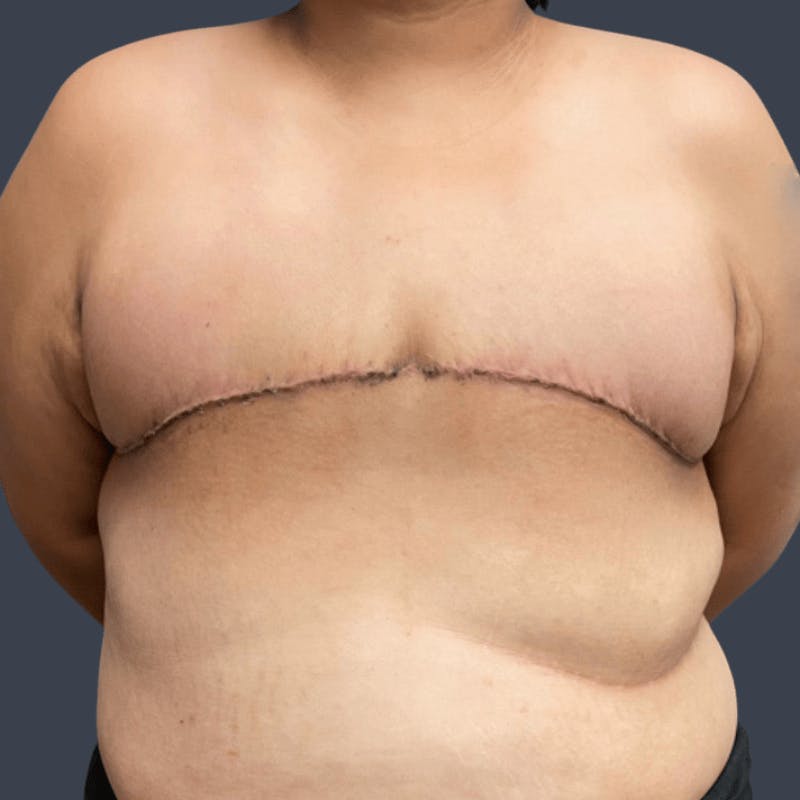 Top Surgery Before & After Gallery - Patient 267043 - Image 4