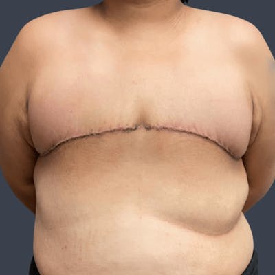 Top Surgery Before & After Gallery - Patient 267043 - Image 2