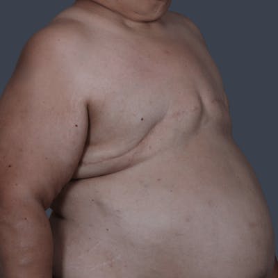 Top Surgery Before & After Gallery - Patient 150310 - Image 1