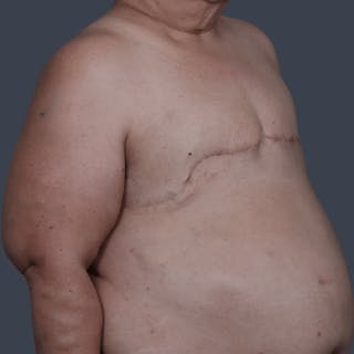 Top Surgery Before & After Gallery - Patient 150310 - Image 2