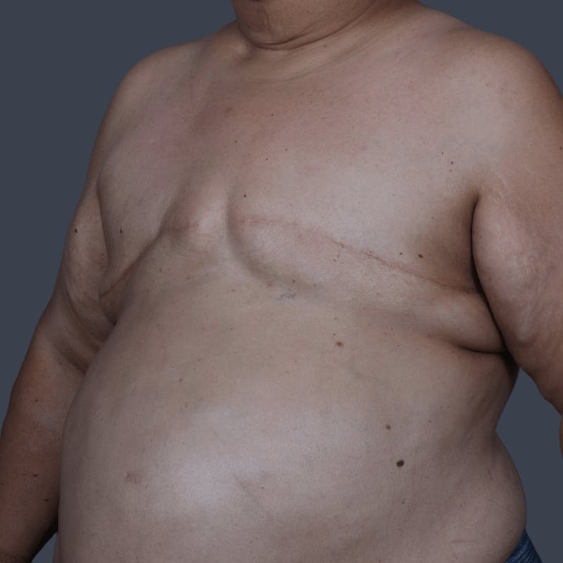 Top Surgery Before & After Gallery - Patient 150310 - Image 3